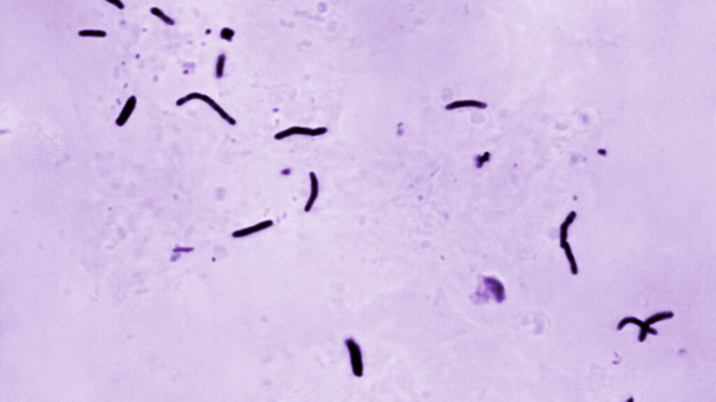 The public health lesson of the Kansas City TB outbreak | STAT