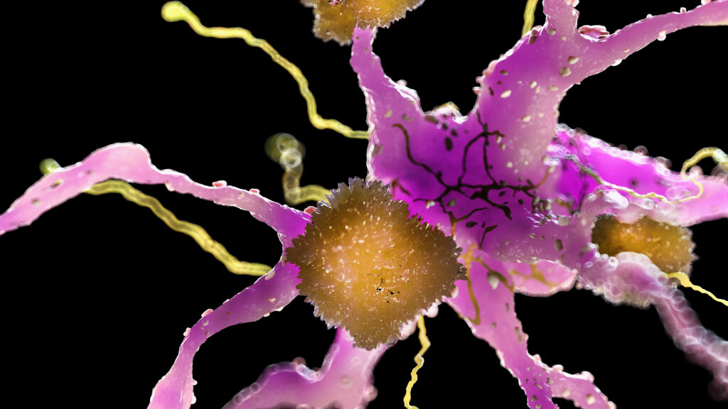Who is benefiting from the amyloid hypothesis of Alzheimer’s? | STAT