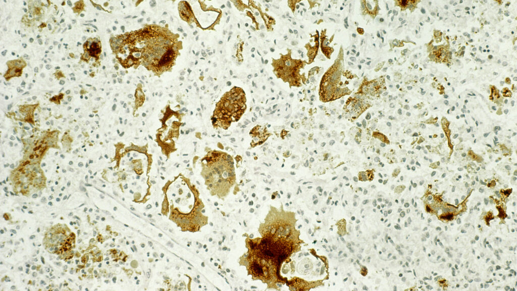 The fleeting miracle of measles elimination | STAT