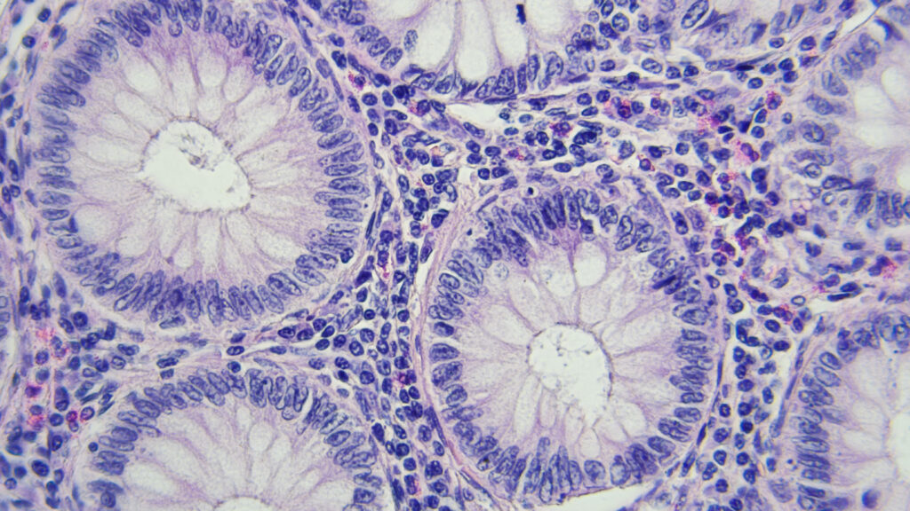 Colon cancer screening guideline change saved lives, studies say | STAT