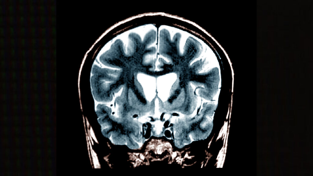 Biotech raises $42 million to run Huntington’s disease trial | STAT