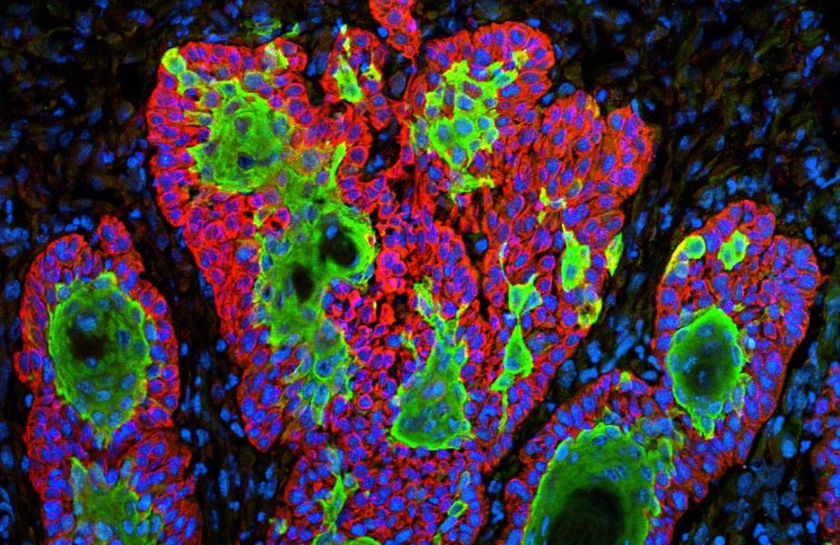 Researchers develop artificial intelligence that can identify cancer cells