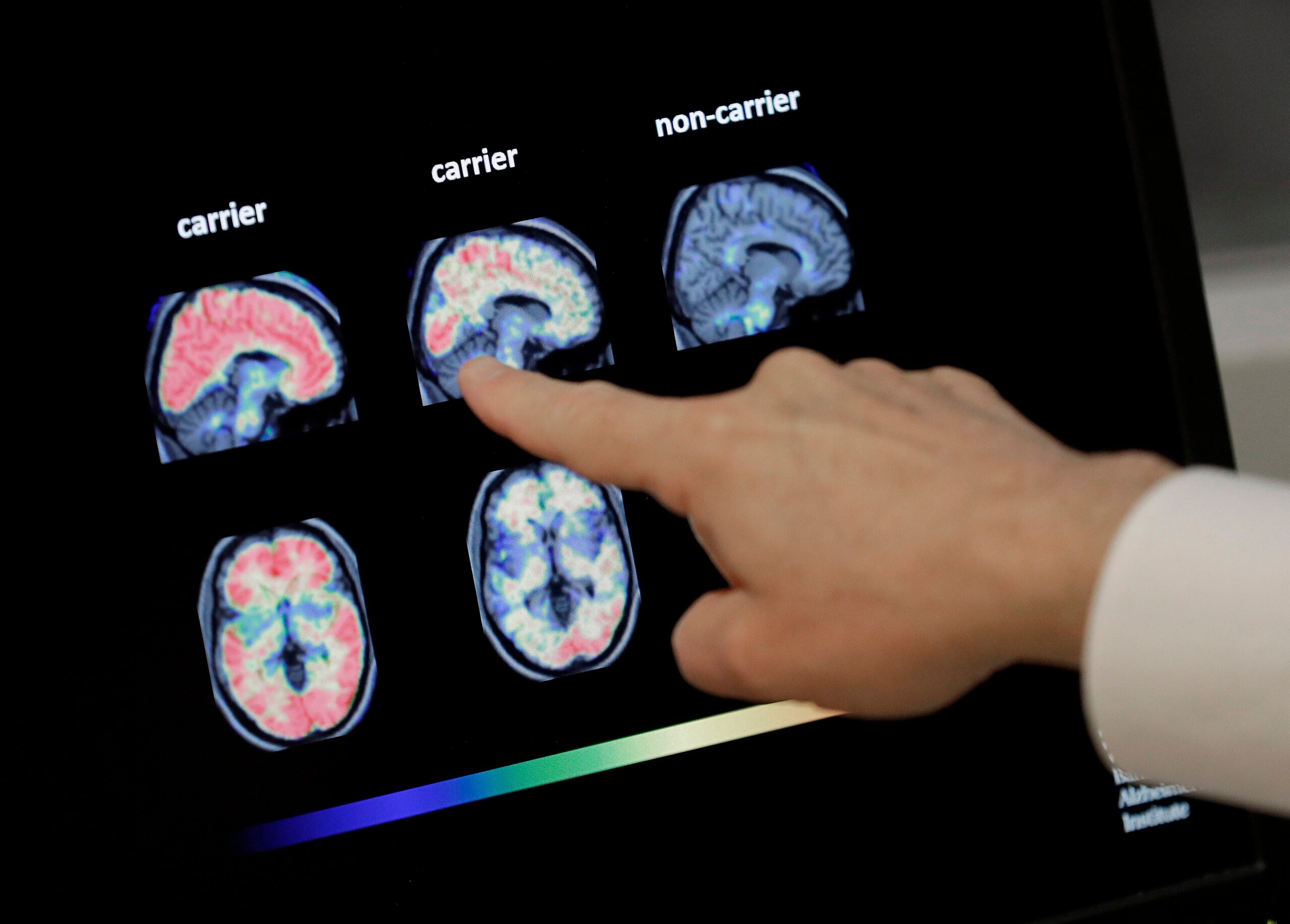 UW-Madison researchers use AI to identify 'sex specific' risk factors in brain tumors - WPR